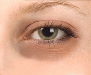 How to remove dark circles around eyes